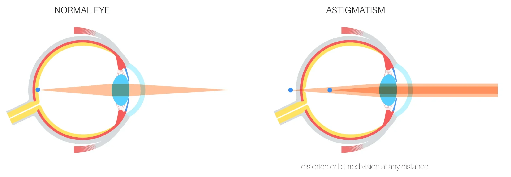 Astigmatism 1 scaled e1765990025484