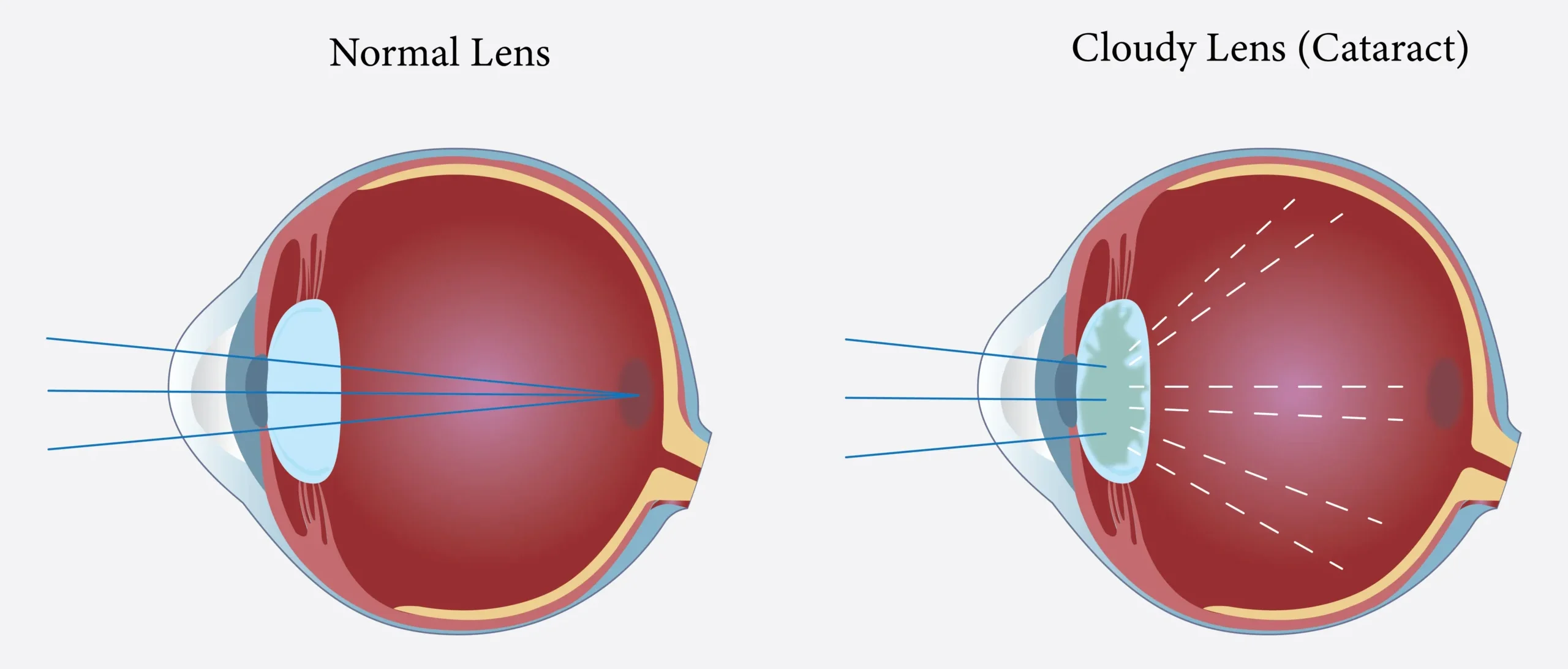 Cataracts 1 scaled e1765989859585