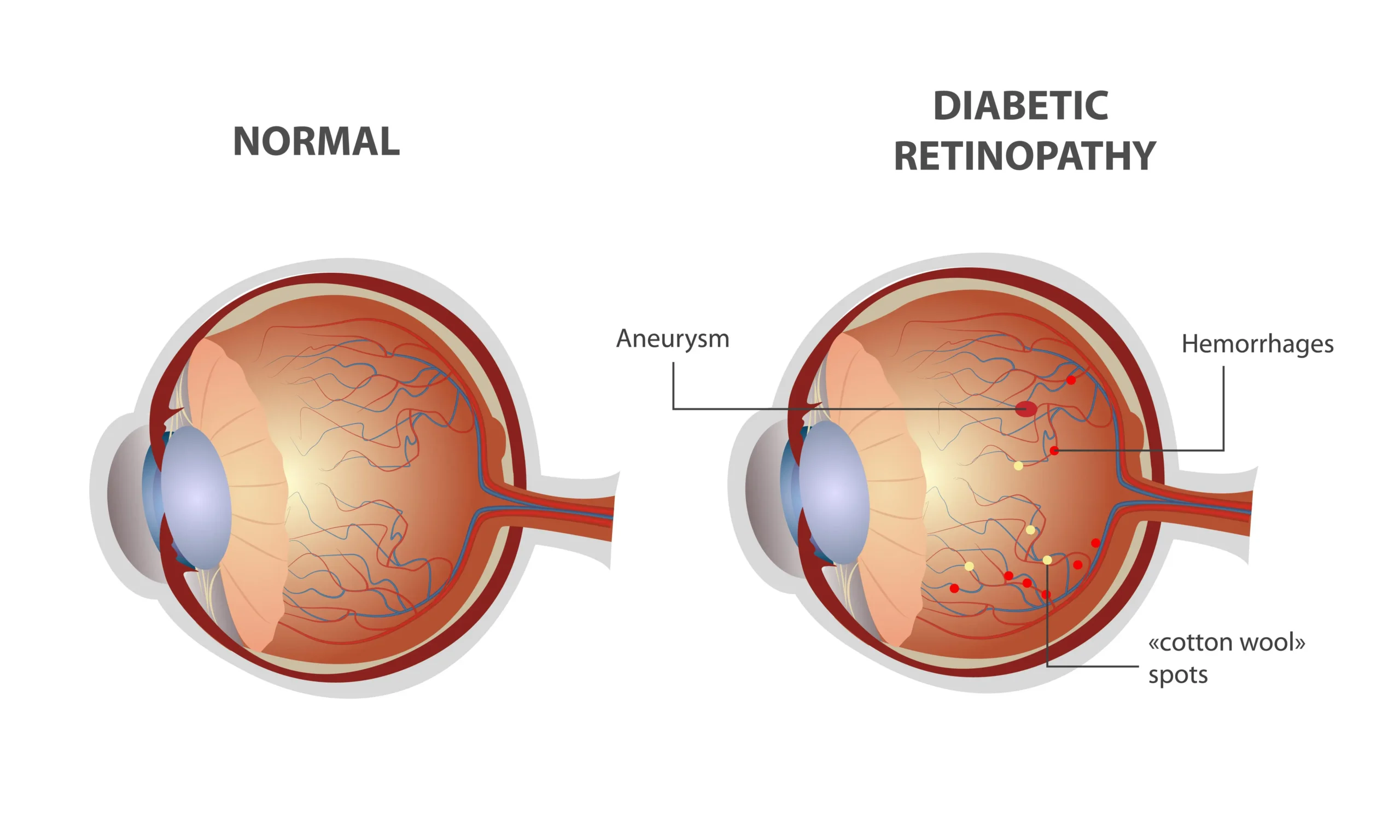 Diabetic Retinopathy scaled