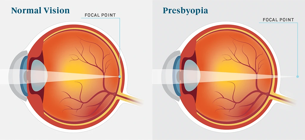 Presbyopia