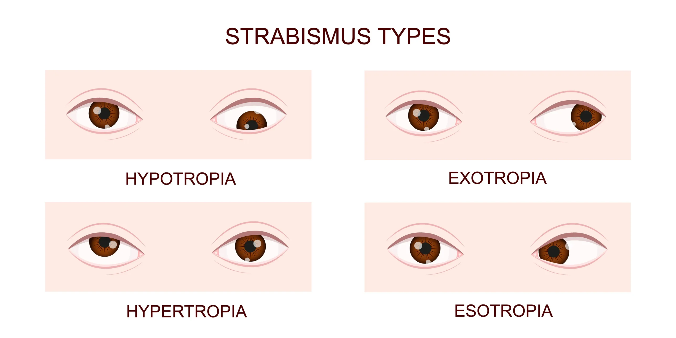 Strabismus scaled