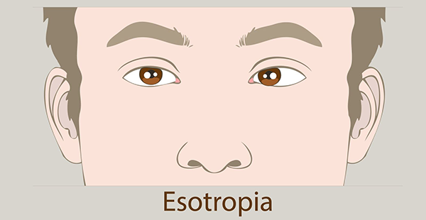 Amblyopia 2 e1765990839290