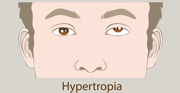 Amblyopia 3 e1765990872777