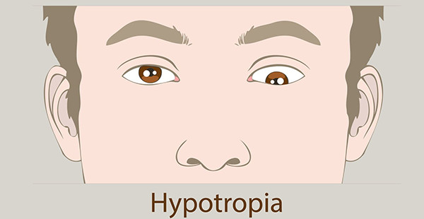 Amblyopia 4 e1765990924166