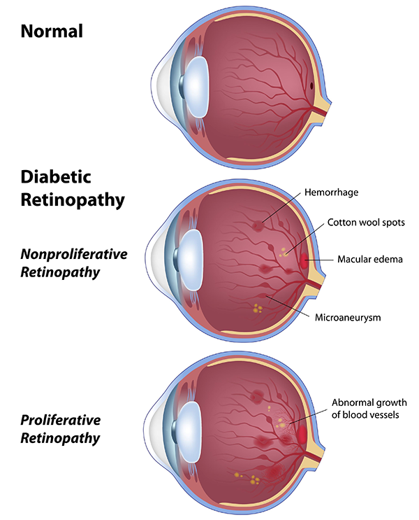 Diabeticretinopathy