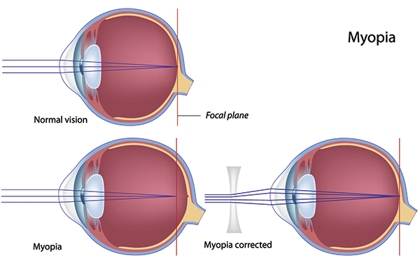 Myopia nearsightedness